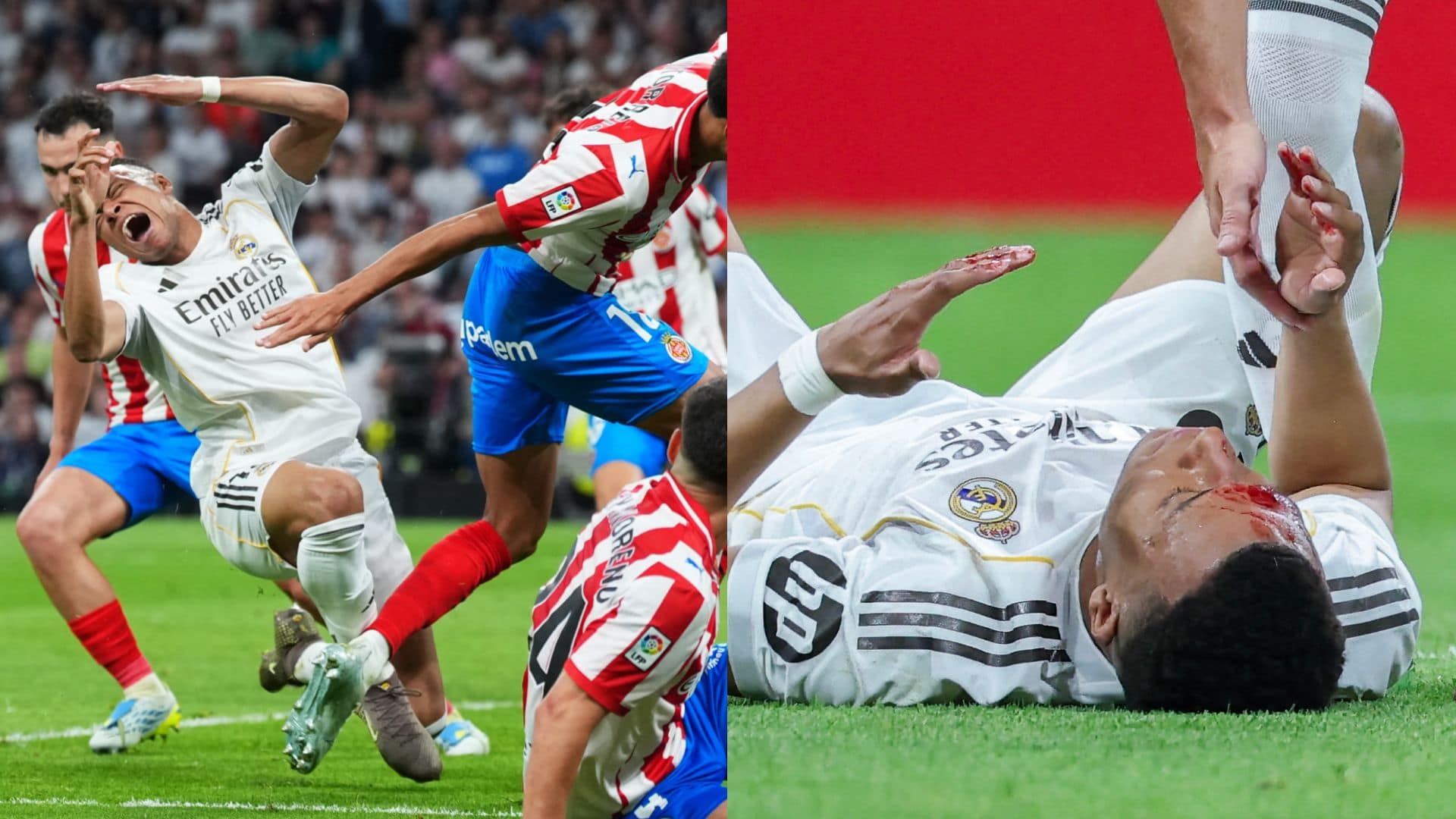 That’s Gotta Hurt! Real Madrid’s Kylian Mbappé Left With Bloody Gash